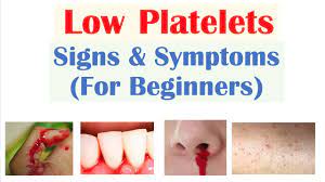 Low Platelets: Signs & Symptoms (Basics For Beginners) - Youtube