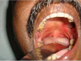 Image result for Erythroplakia roof of mouth