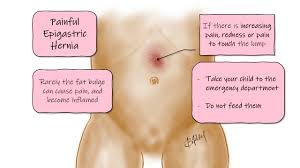 Image result for stomach hernia symptoms