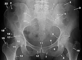 Systematically examine all bony structures of the pelvis and femurs for symmetry, cortical breaks and joint spaces (sacroiliac, hip and. Radiographic Anatomy Of Adult Pelvis Orthopaedicsone Articles Orthopaedicsone