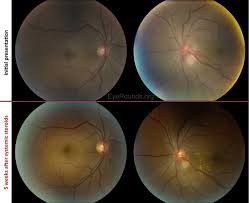 Towel or gauze to dry the site. Unilateral Optic Nerve Granuloma