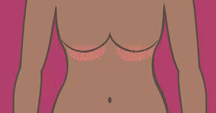 Image result for Intertrigo under breasts