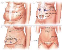 I remind patients that any type of tummy tuck operation involves significant physical and emotional recovery and offer the following words of advice: Speed Up Your Tummy Tuck Recovery
