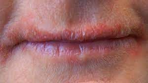 The ointments can help to soften the crust of the sores, numb the blisters, and relieve the pain. Bumps On Lips Causes Treatments And More