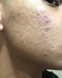 Read my story to see what worked and what changed my life. Acne How Do I Get Rid Of My Fungal Acne Closed Comedones Fungal Acne Dead Skin Cells Daily Skin Care