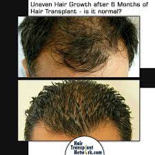 Uneven Hair Growth After 6 Months Of Hair Transplant Is It Normal Hair Transplant Hair Transplant Surgery Hair Loss Symptoms