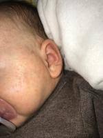Hat der mensch am körper viele stellen, wo der betroffene immer wieder pickel finden kann, so ist selbst das ohr von diesen hautveränderungen nicht verschont. Pickel Und Kruste Am Ohr Forum Baby Urbia De