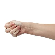 Test for presence tenosynovitis of the extensor policis brevis and abductor policis longus tendons. A Closer Look At De Quervain S Syndrome And Orthotic Management