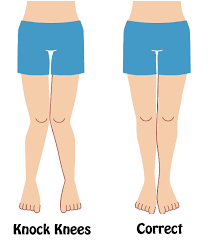 Fortunately, your talkative knees are usually not a cause for concern. What Exercises Help To Cure Knock Knees Quora