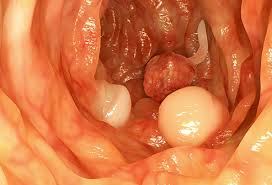 Read about the symptoms, causes, treatments and when to see a nasal polyps are painless soft growths inside your nose. Polyp Pictures What They Are And What Polyps Look Like