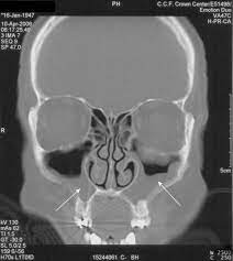 Sinusitis