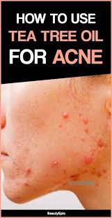 How To Use Tea Tree Oil For Acne Tea Tree Oil For Acne Tea Tree Oil Tea Tree Oil Uses