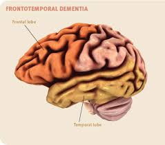 Check spelling or type a new query. Dementia 101 Know The Different Types Of Dementia