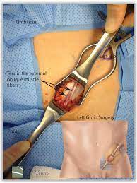 Surgery for chronic athletic groin pain can be classified into open and laparoscopic techniques. Hernia Types Sports California Hernia Specialists