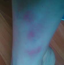 Узловая эритема — это достаточно часто встречающаяся дерматологическая патология, при которой в сосудах, расположенных в коже, развивается воспалительный процесс. Uzlovataya Eritema Flebologiya Forum Otzyvy Obsuzhdeniya