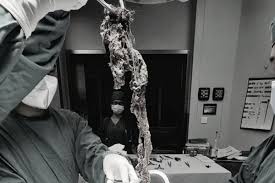 ラプンツェル 症候群