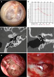Image result for Ossicular Chain Disruption