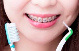 Como Cepillarse Los Dientes Con Brackets