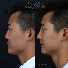 1 Rhinoplasty & Facelift Surgeon in New York