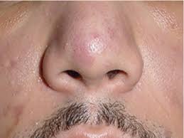 Dec 02, 2020 · kaposi's sarcoma is a type of cancer that forms in the lining of blood and lymph vessels. Kaposi Sarcoma Review And Medical Management Update Oral Surgery Oral Medicine Oral Pathology And Oral Radiology