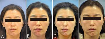 Parry-Romberg Syndrome Augmented by Hyaluronic Acid Filler