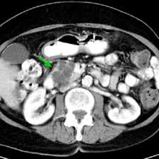 Sushma2 department of pathology, mamata medical college, khammam. Histologic Findings Of Benign Multicystic Mesothelioma Of The Pancreas Download Scientific Diagram