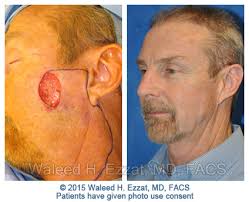 They are going to remove it in office and look at … bienvenidos learn how to use mayo clinic connect community guidelines help center request an appointment my husband h. Skin Cancer Surgery Mohs Reconstruction Boston Medical Center