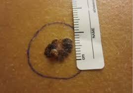 Impacts of Artificial Intelligence and New Technology for Melanoma Detection