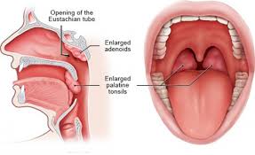Here's what causes this side effect along with how to soothe it and prevent it in the first place. Enlarged Tonsils Diagnosis And Treatment San Diego Sdents