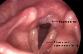 Image result for Reflux Laryngitis