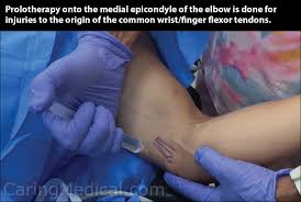 Image result for Epicondyle Injection