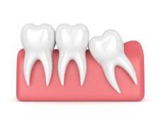Remain completely hidden within the gums. What Happens If You Don T Get Your Wisdom Teeth Removed Preventive Dentistry Charlottesville Dentist Dr Jack T Kayton