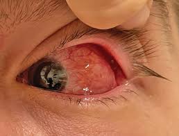 Image result for Dacryoadenitis