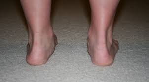 Correcting Overpronation Overpronation Posture Fix Foot Exercises