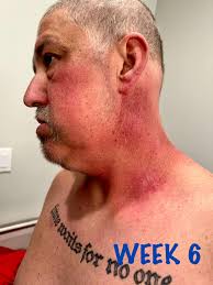My husband recently had skin cancer surgery. The area at his neck was super  invasive. He has two stitched areas at least 5” long each. Thankfully after  four passes they got it