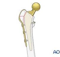 Compression plate and screw fixation for Trochanteric ...