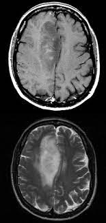 Glioblastoma Wikipedia