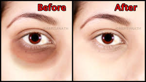 Get Rid Of Under Eye Dark Circle Puffiness Fine Lines In 1 Week Mag Undereye Dark Circles Puffiness