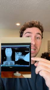 It’s so weird #fusion #sci #paralyzed #unexpected #disabled