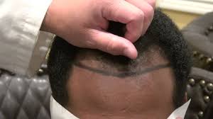 Here we shall discuss some ways by which you can fix a bad hairline. Black Man Receding Hairline And Corners Transplant Surgery Dr Diep Www Mhtaclinic Com Bay Area Ca Youtube