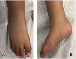 Because your newborn's bones, joints and tendons are very flexible, treatment for clubfoot usually begins in the first week or two after birth. Meningomyelocele With Unusual Feet Deformity Combination A Report Of A Rare Case Sciencedirect