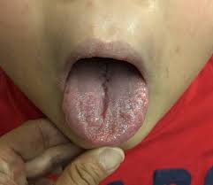 Image result for Fissured tongue