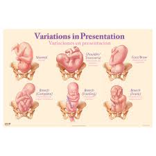 Image result for Shoulder Presentation