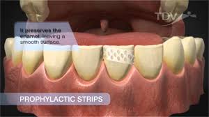 Tepe interdental brushes for cleaning between, where a regular brush doesn't reach sizes: Prophylactic Strips Tdv Tartar Removal Youtube