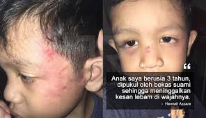 Jika terjadi pembekuan darah di kepala sebaiknya di kompres dengan air hangat krn mengompres dengan air dingin hanya akan membuat pembuluh darah semakin sebaliknya jika luka memar, maka di kompres dengan ir dingin agar pembuluh darah membeku dan darah berhenti mengalir. Budak 3 Tahun Lebam Di Mata Darah Beku Dalam Telinga Akibat Dipukul Bapa The Reporter