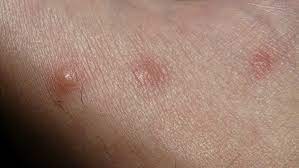 Allergic Reaction To Spider Bites Spider Bite Treatment
