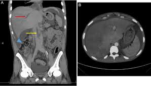 Budd Chiari Syndrome A Rare And Life Threatening Complication Of Crohn S Disease Bmj Case Reports