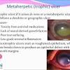 Keratitis is a common condition. Https Encrypted Tbn0 Gstatic Com Images Q Tbn And9gctehgzdd 88sqro8fbnrmyxq6c1njx1igyvvh8ikm 1w9j32dwd Usqp Cau
