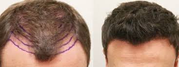 Please clarify me for the below questions: Should I Use Minoxidil After Hair Transplant Hair Transplant Dubai