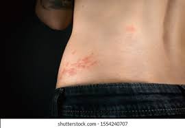 Please visit our site for. Shingles Outbreak On Torso Woman Varicellazoster Stock Photo Edit Now 1554240707